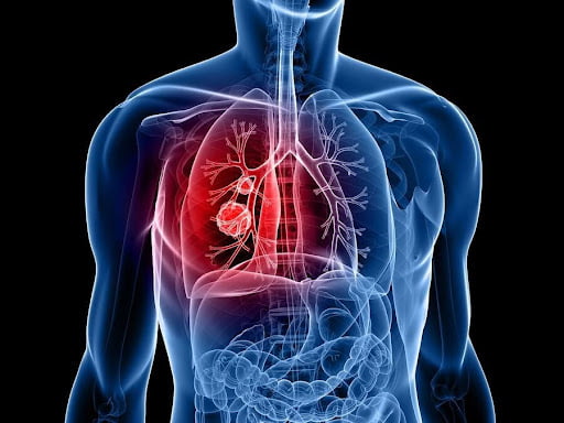 ביופסיה נוזלית: הדרך הטובה ביותר לניטור הטיפול בסרטן ריאה - Oncotest