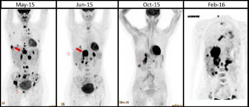 תמונות מצב של התפתחות סרטן הריאות אצל המטופלת - Oncotest