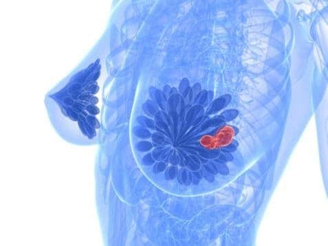 סרטן השד, דחיית הליכים כירורגיים בעידן מגפת הקורונה - Oncotest